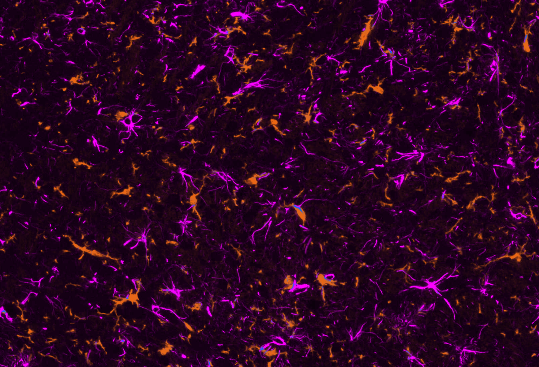 Iba-1-positive microglia and GFAP-positive astrocytes in the injected SNc of an AAV-Tau mouse.