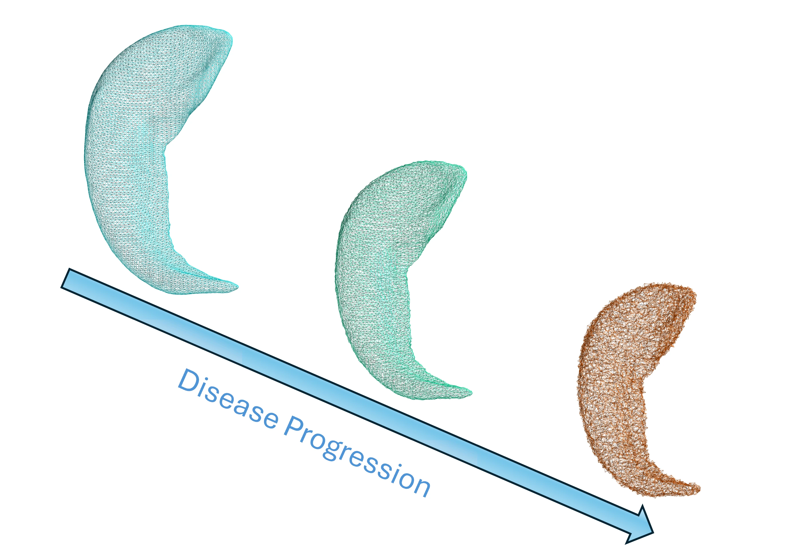 Hippocampus shape changes as disease progresses