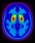 Pseudo DaTscan Image