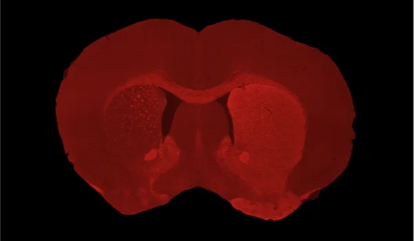 Dopaminergic denervation of ipsilateral striatum shown by tyrosine hydroxylase immunostaining