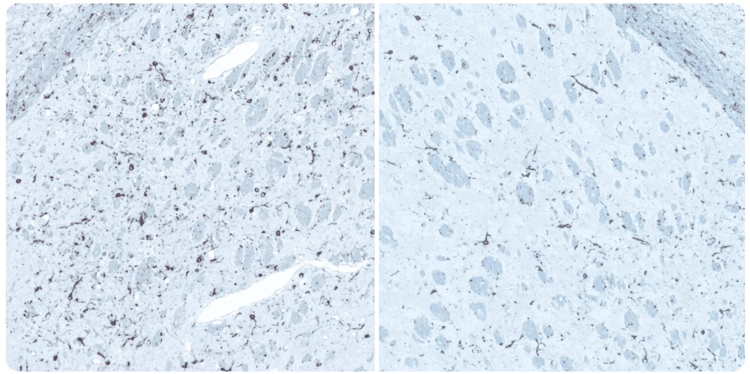 mmunohistochemistry (IHC) staining of brain tissue sections to reveal alpha synuclein burden in anterior olfactory nucleus (AON), associated with Parkinson's Disease (PD)