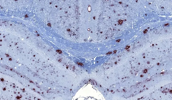 Alzheimer’s Disease - IHC staining