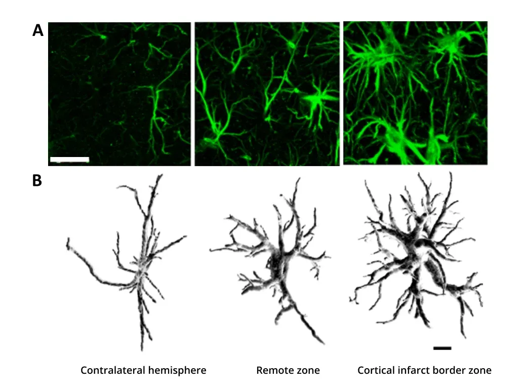 Hypertrophy of astrocytes due to brain ischemia