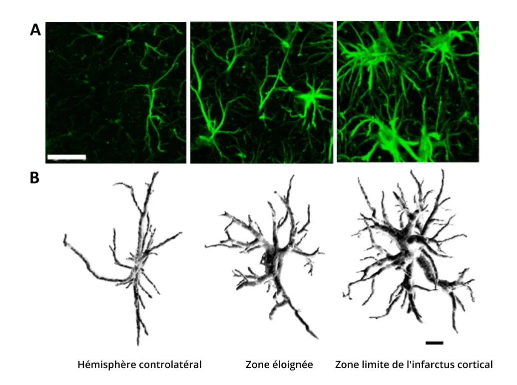 Hypertrophie des astrocytes due à l'ischémie cérébrale