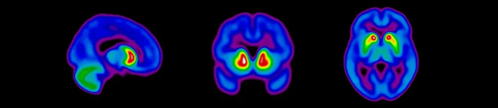 Different views of dopaminergic imaging scans for assessing subject eligibility for Parkinson's disease clinical trials