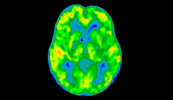 ASL perfusion MRI scan image of human brain