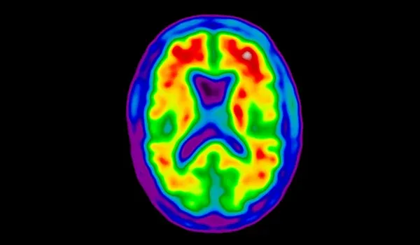 Amyloid PET scan image of human brain