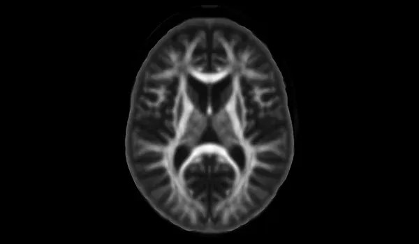 Image du cerveau humain obtenue par IRM de diffusion