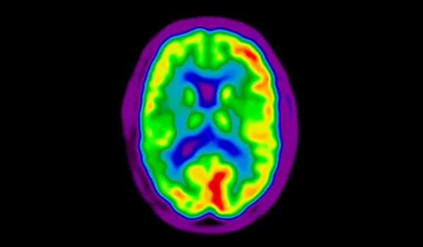 FDG PET scan image of human brain