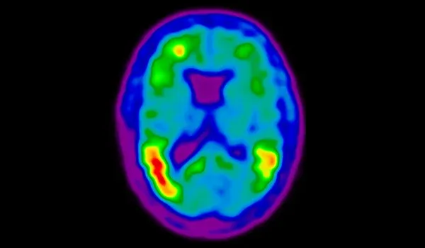 Tau PET scan image of human brain