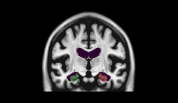 IRM volumétrique du cerveau humain