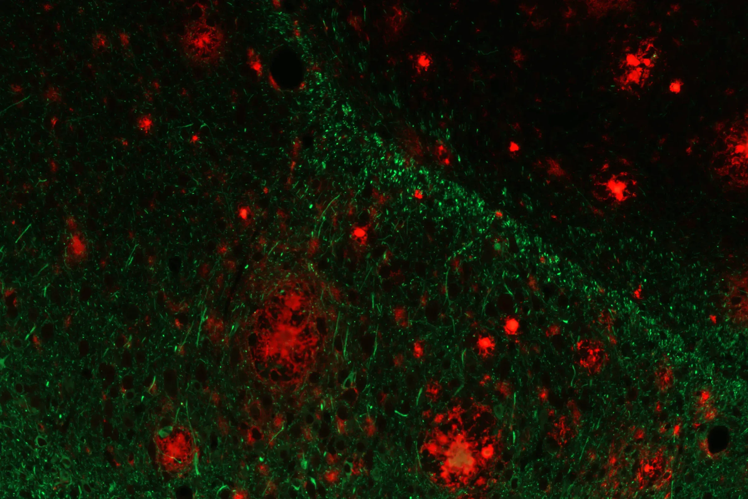 Co-Pathology Model - amyloid & tau