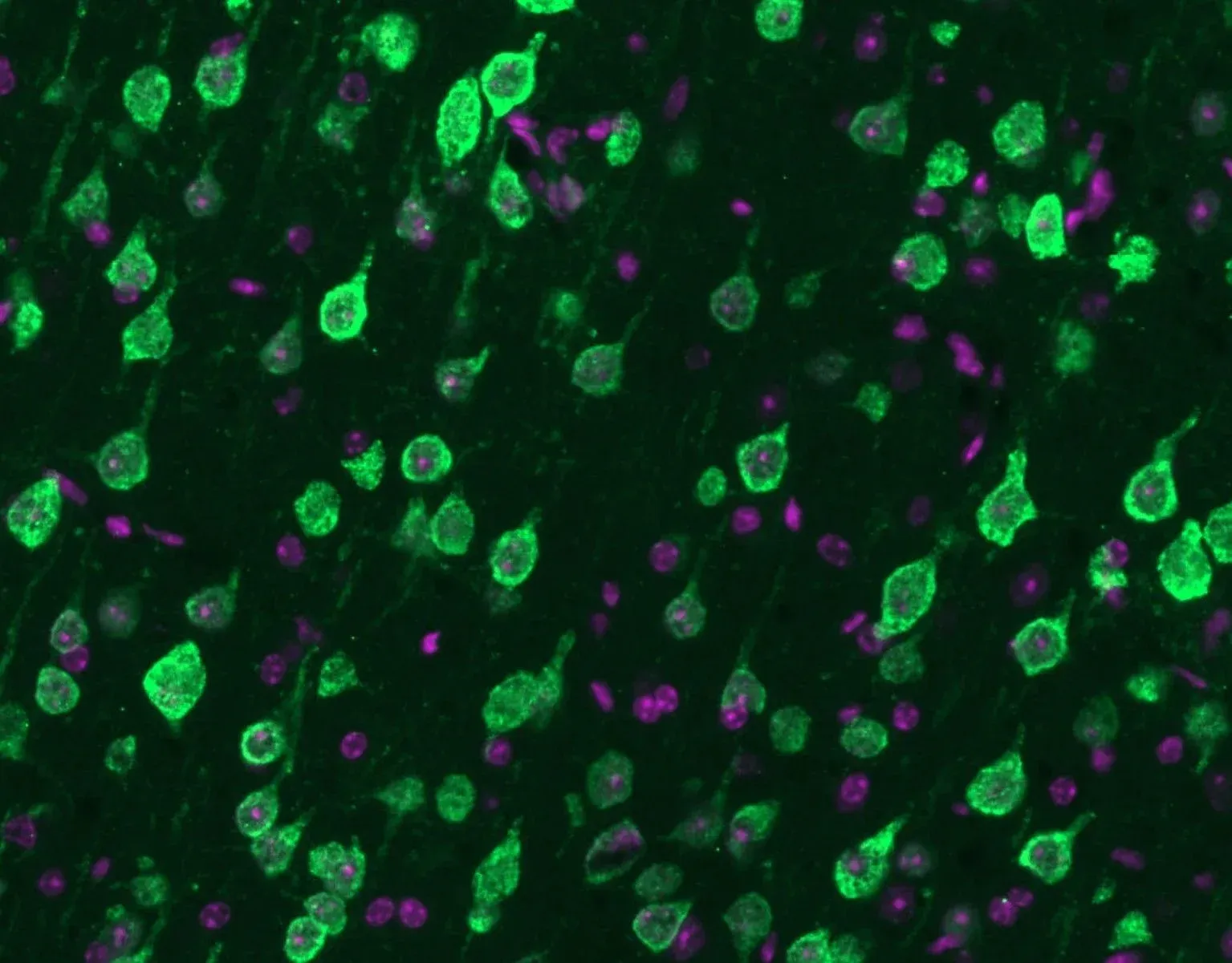 Mislocalization of TDP-43 from the nucleus to the cytoplasm. 