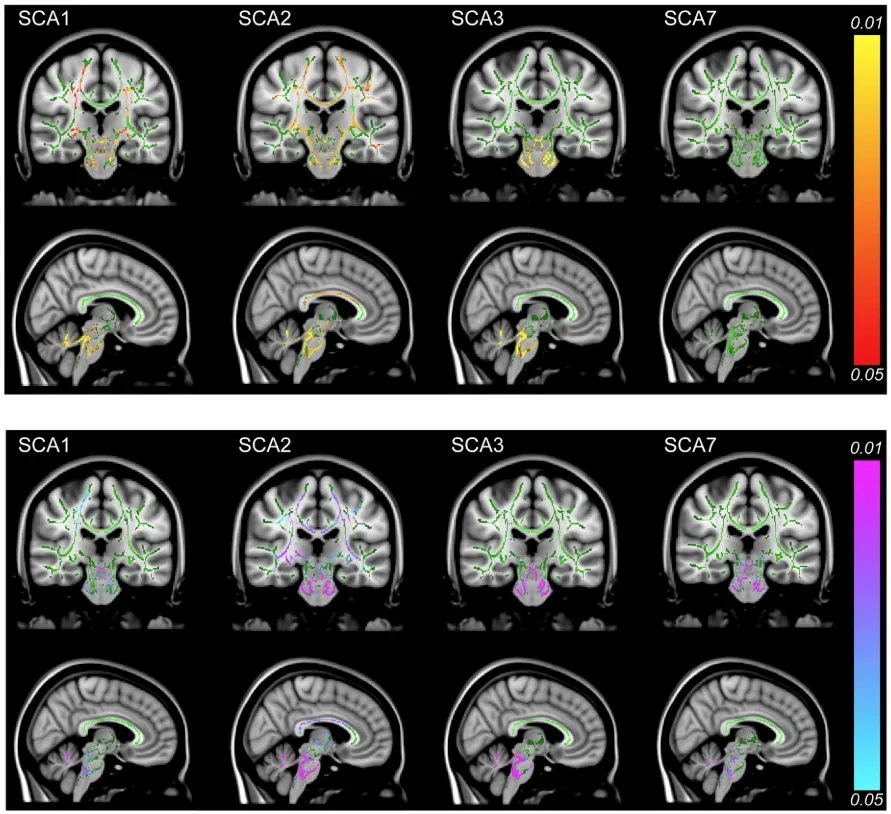 Spinocerebellar Ataxia DTI