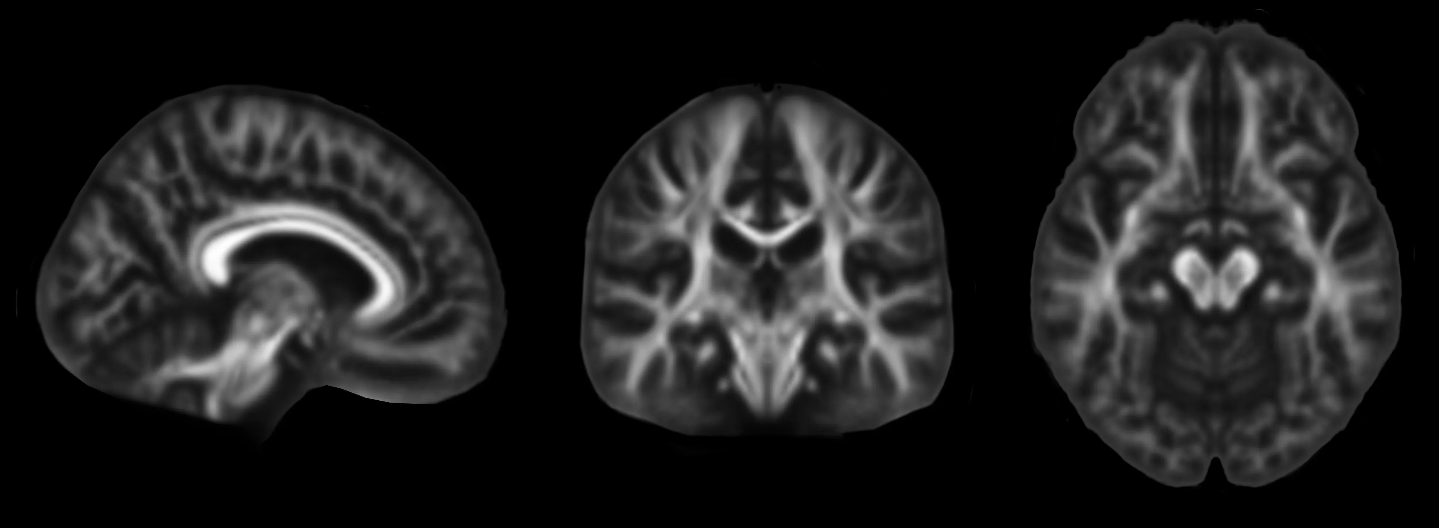 Orthogonal views of fractional anisotropy (FA) maps derived from DTI data