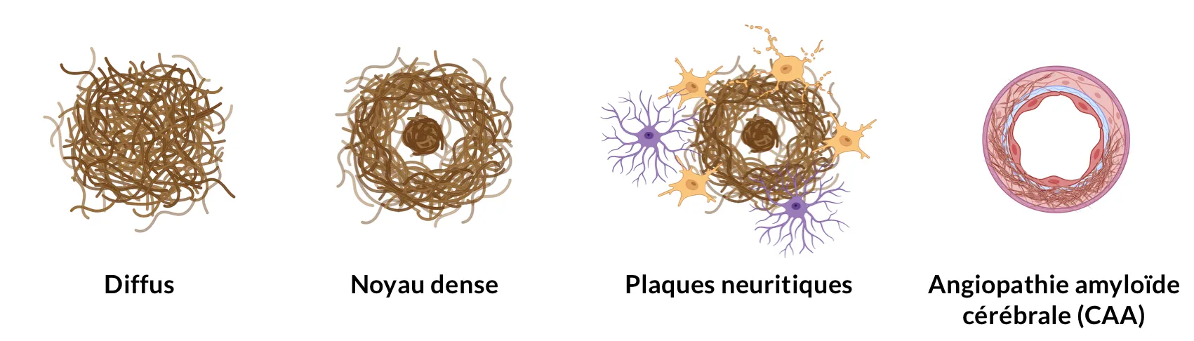 Illustration des différents types de plaques amyloïdes-β.