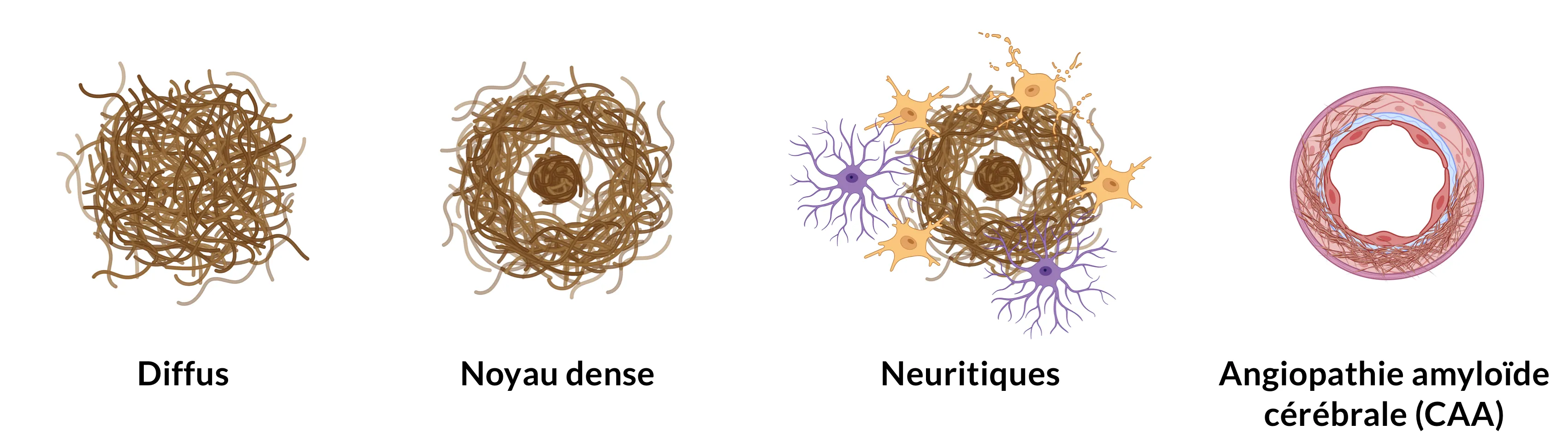 Illustration des différents types de plaques amyloïdes-β.