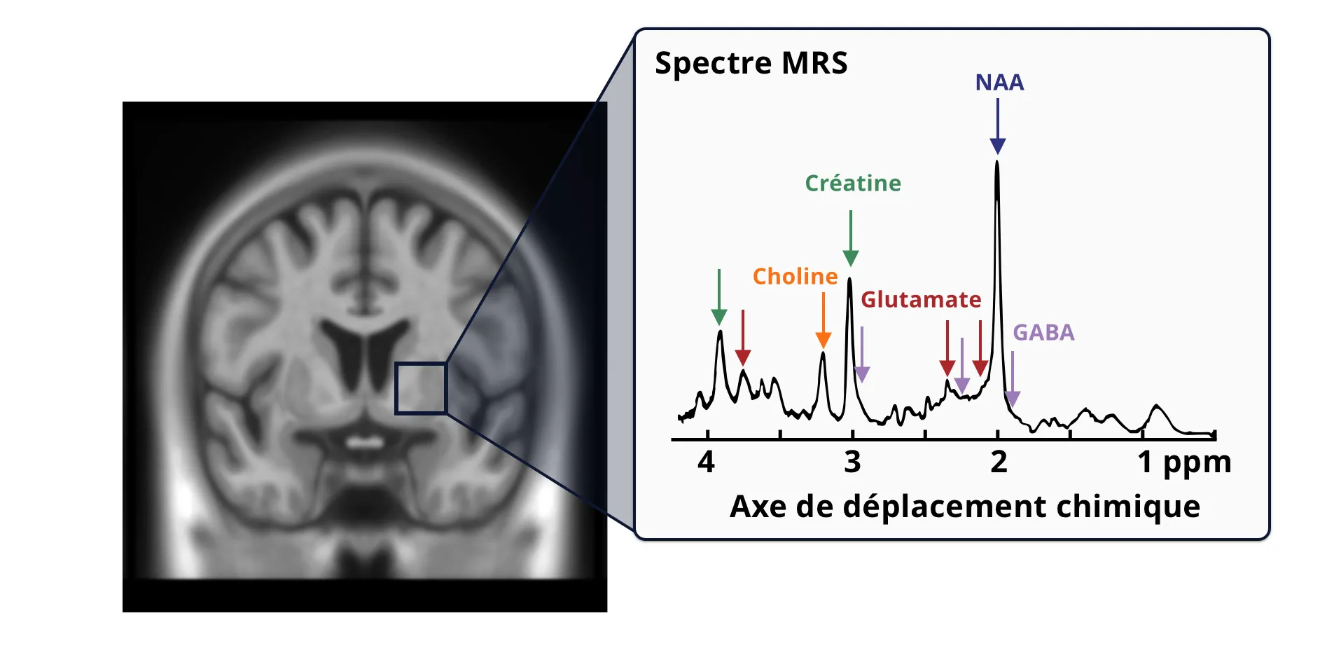 Signaux de métabolites acquis à l'aide d'un spectre 1H-MRS