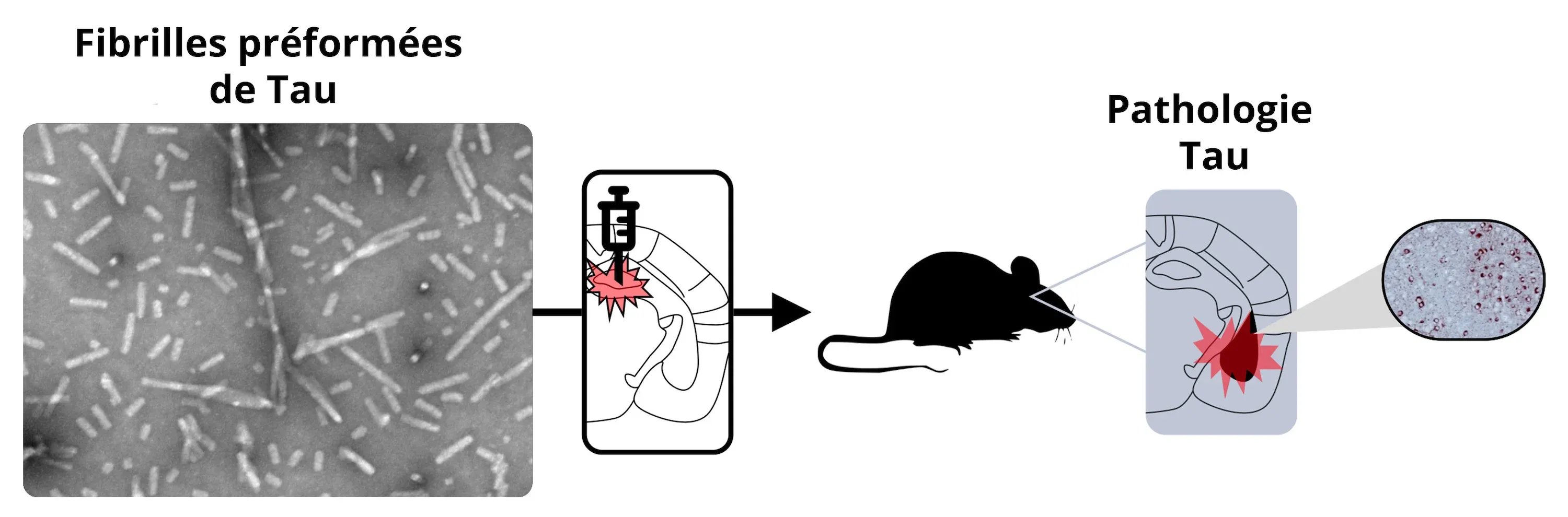 Maladie d'Alzheimer - Modèle Tau PPF Processus