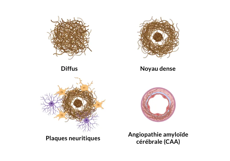 Différents types de plaques amyloïdes-β