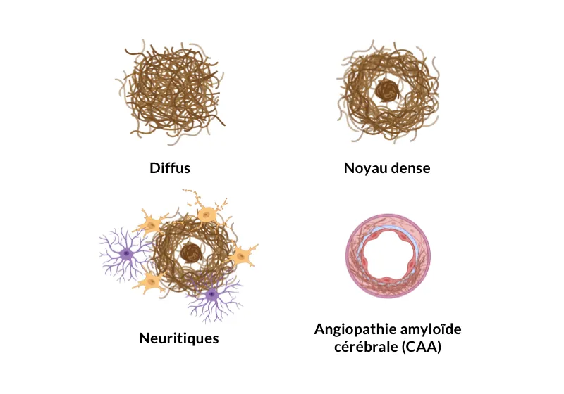 Différents types de plaques amyloïdes-β