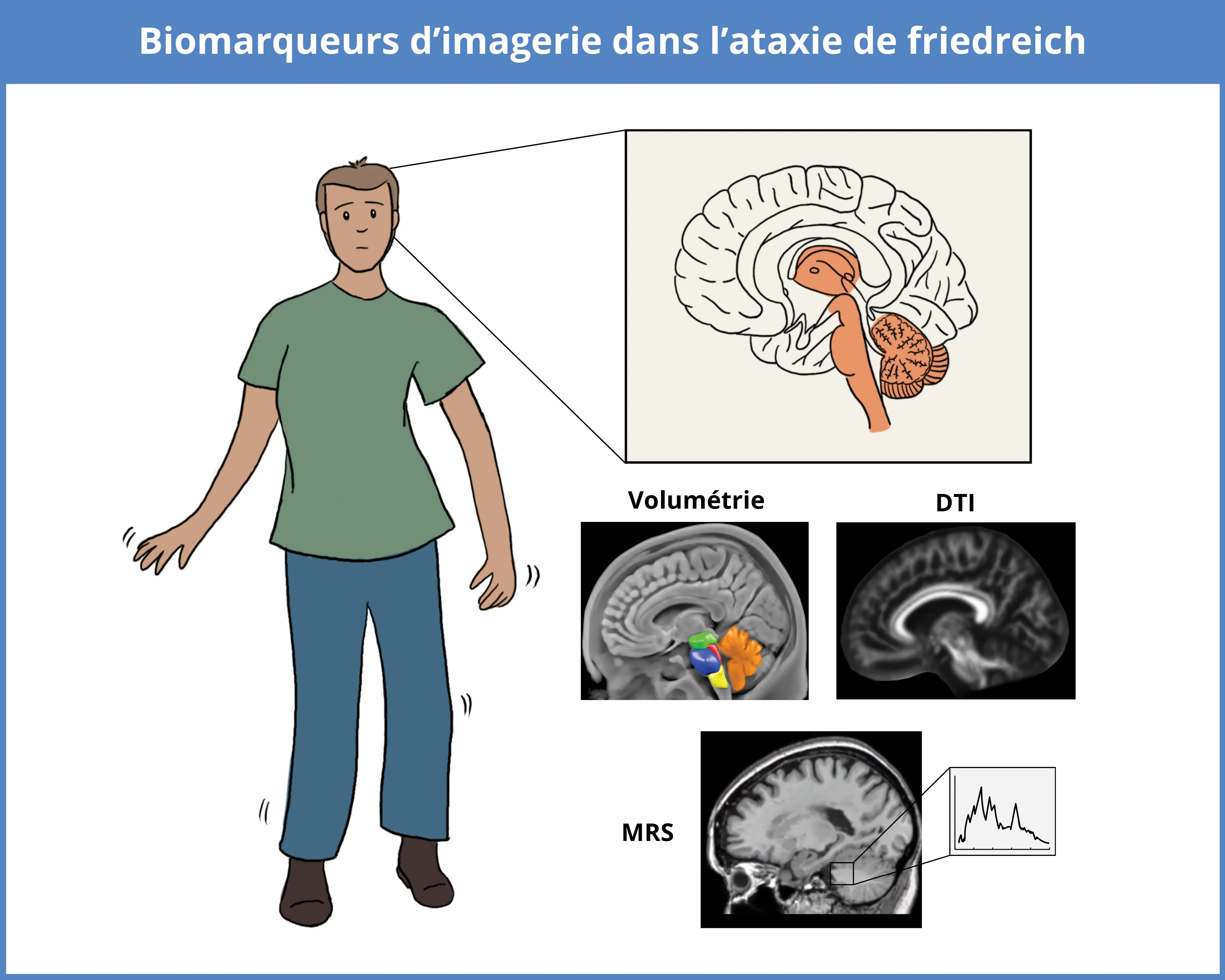 Biomarqueurs d'imagerie FRDA