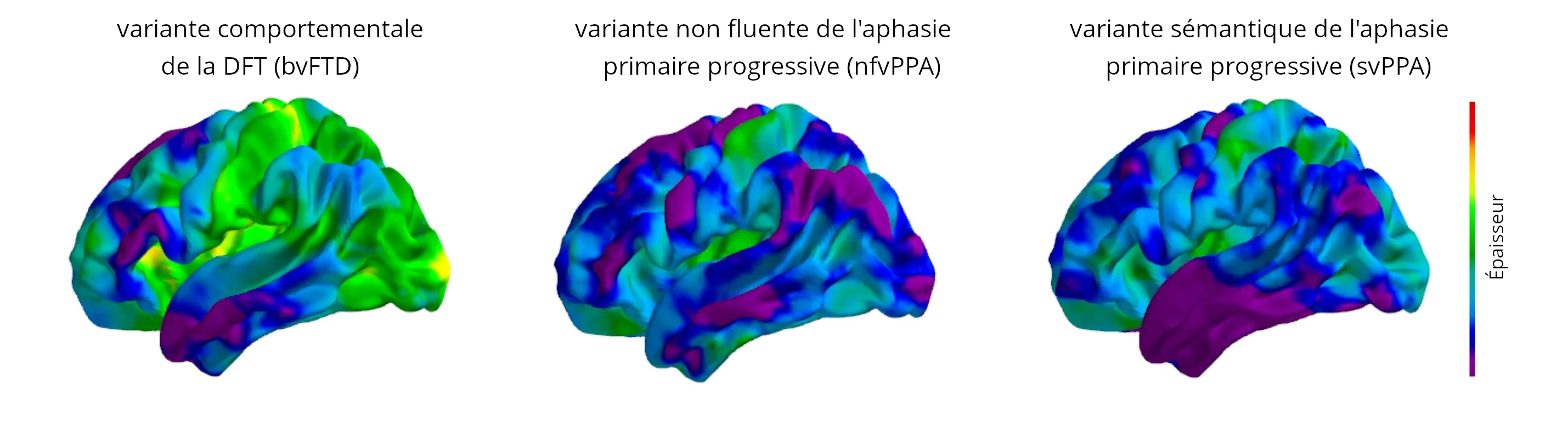 Illustration des changements progressifs de l'épaisseur corticale sur une période de 12 mois.