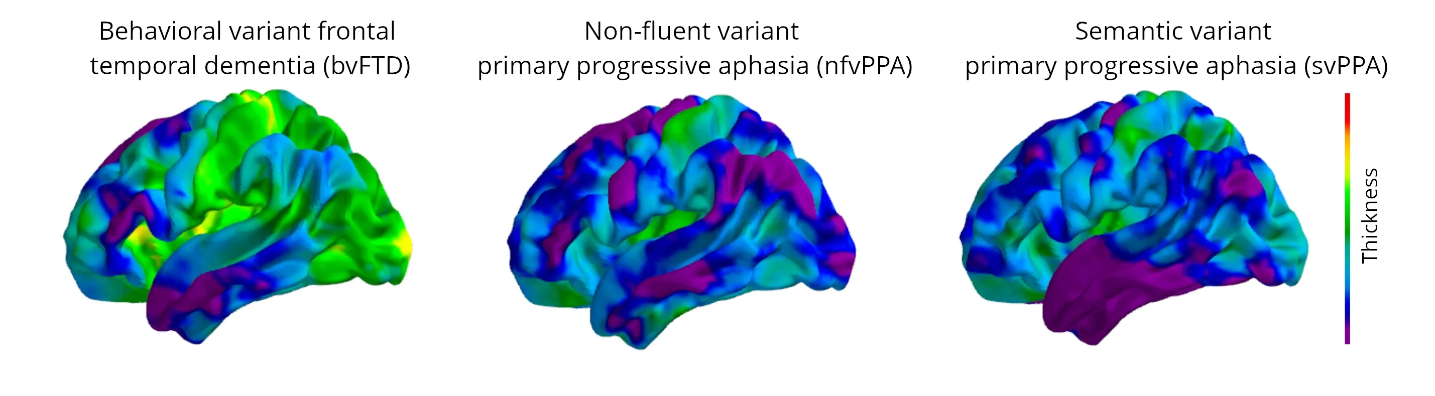 Illustration of progressive changes in cortical thickness over a 12-month period.