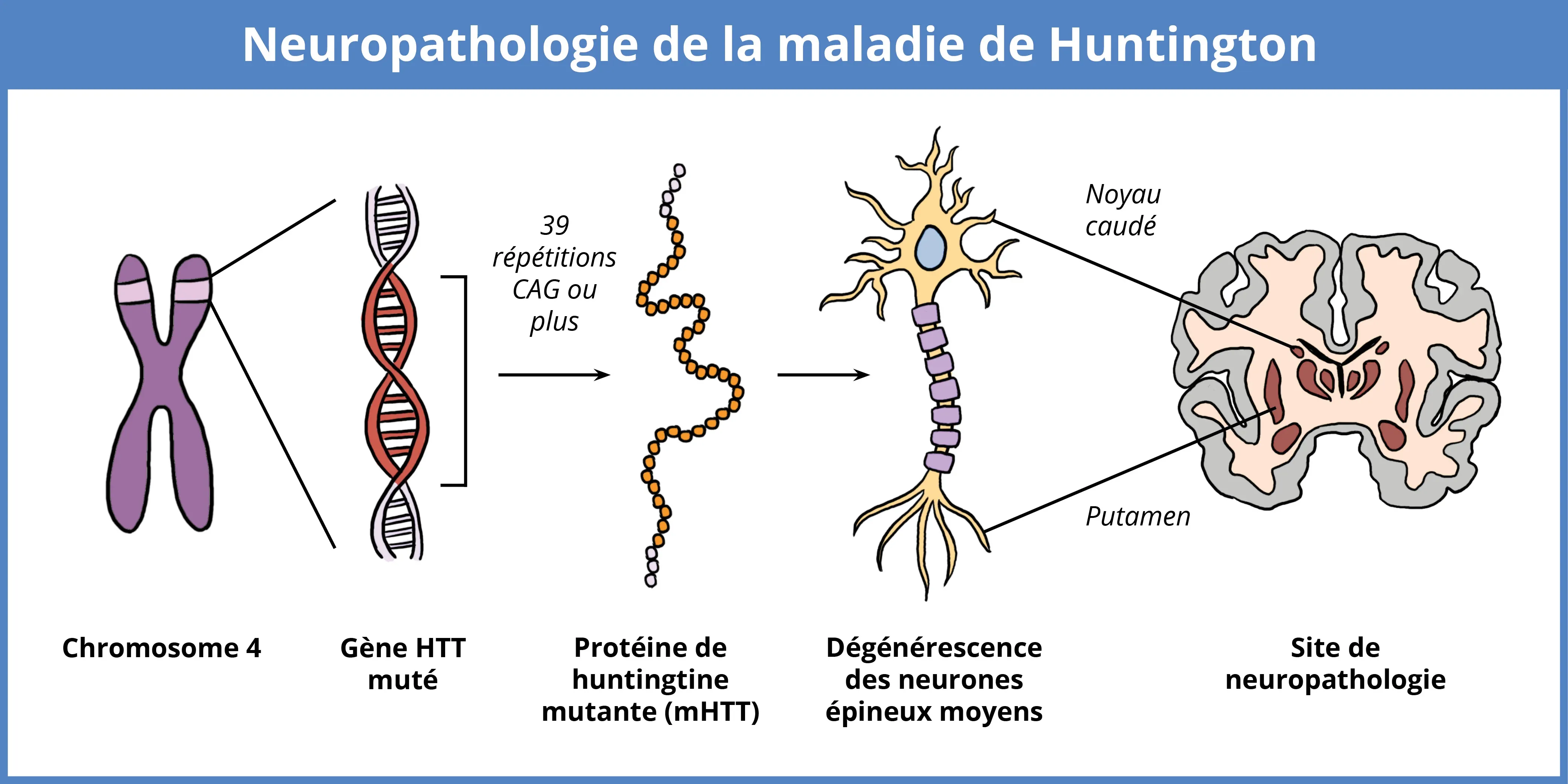 Neuropathologie Huntington