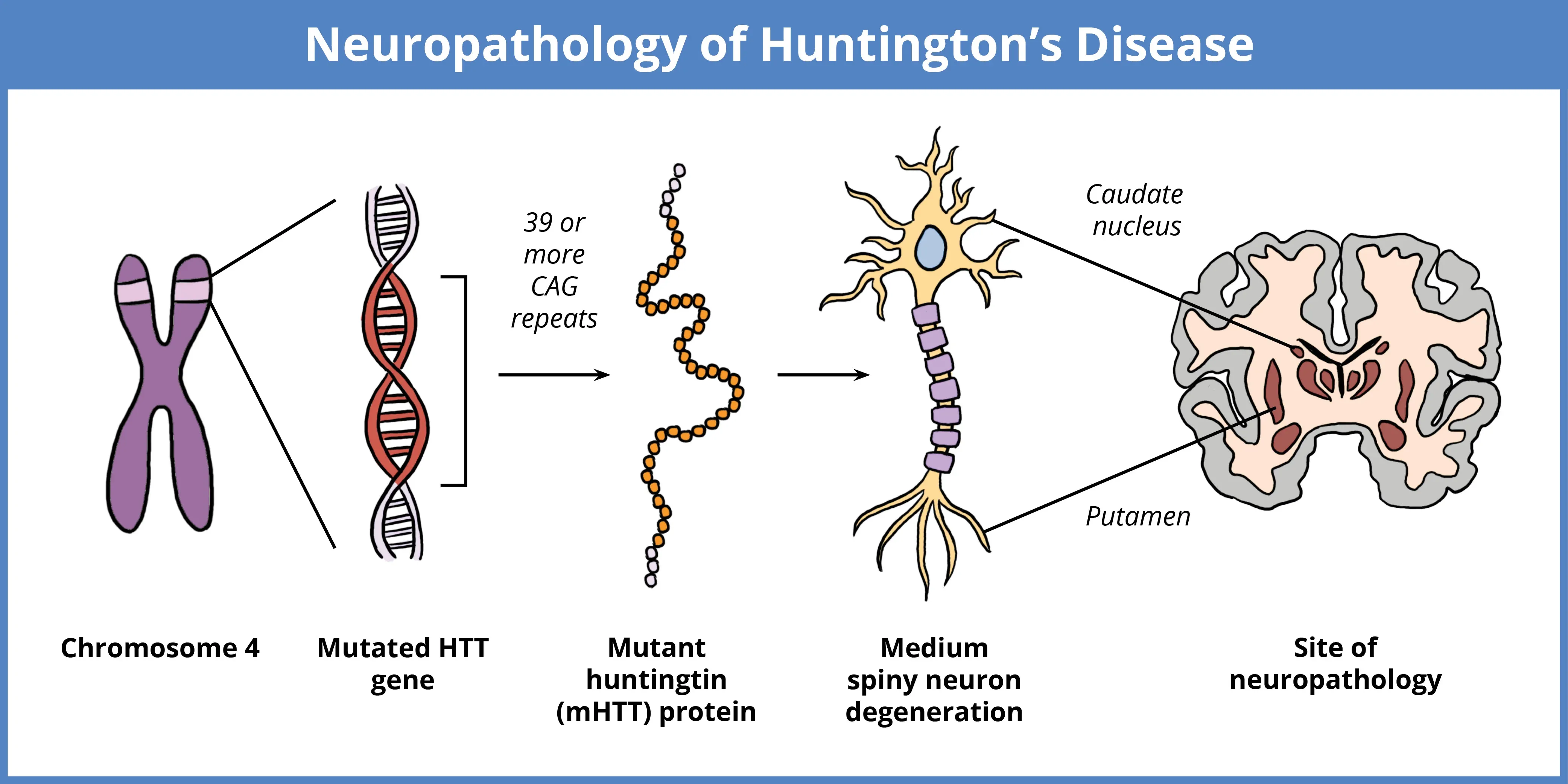 Huntington's Neuropathology