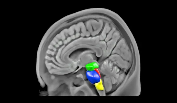 MRI 체적 측정 뇌간 중뇌