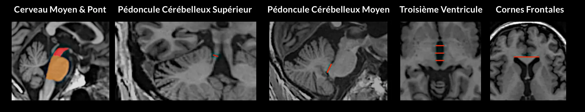 Indice de parkinsonisme par résonance magnétique (MRPI) d'un patient atteint de PSP