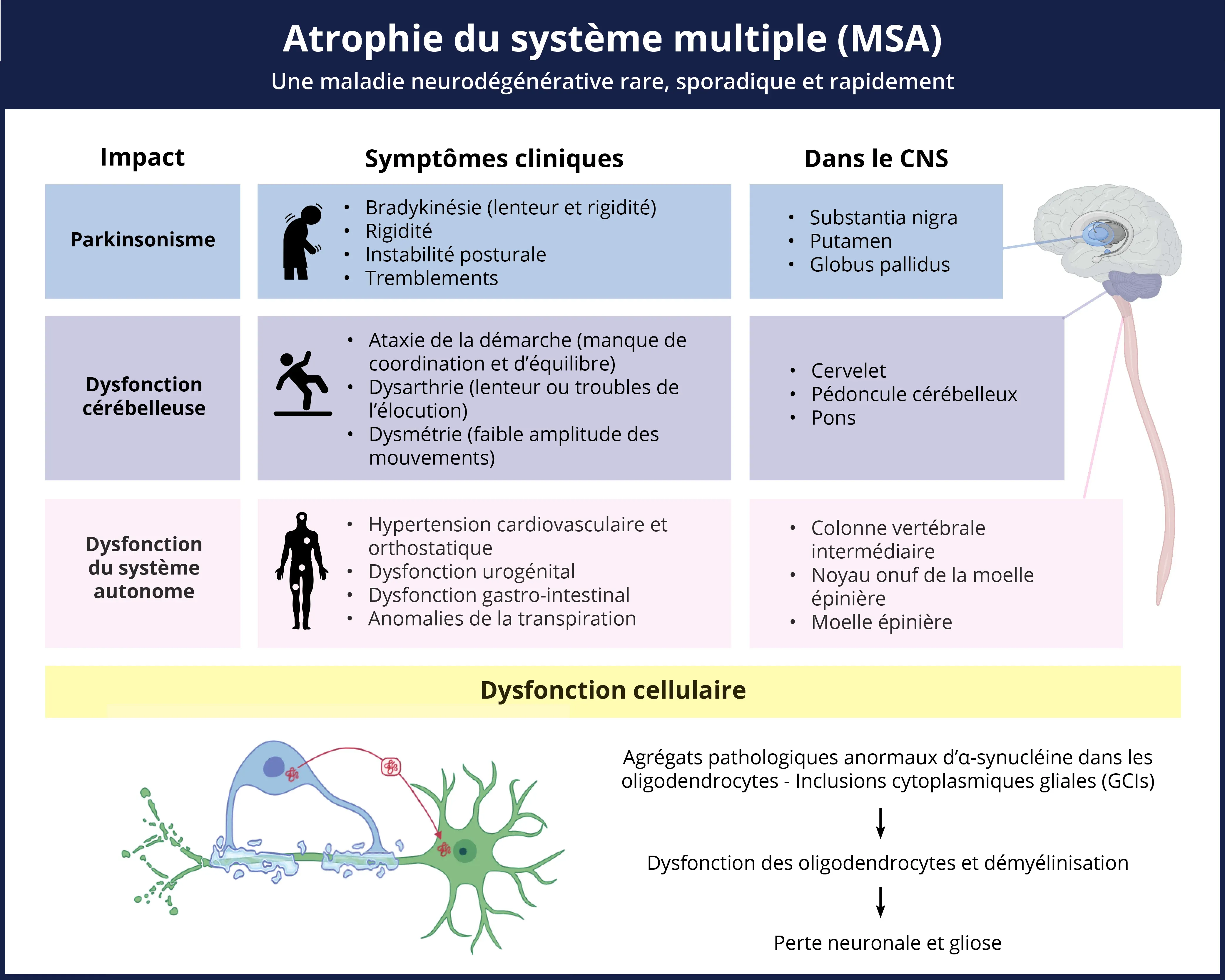 Symptômes de l'atrophie multisystémique et changements pathologiques dans l'ensemble du CNS