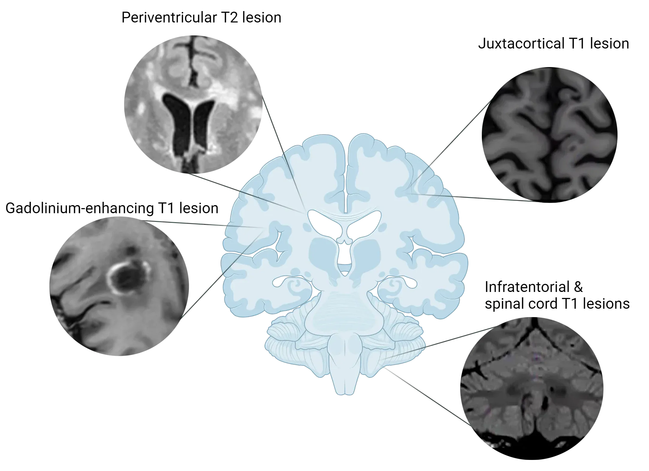 MS lesions in various brain locations