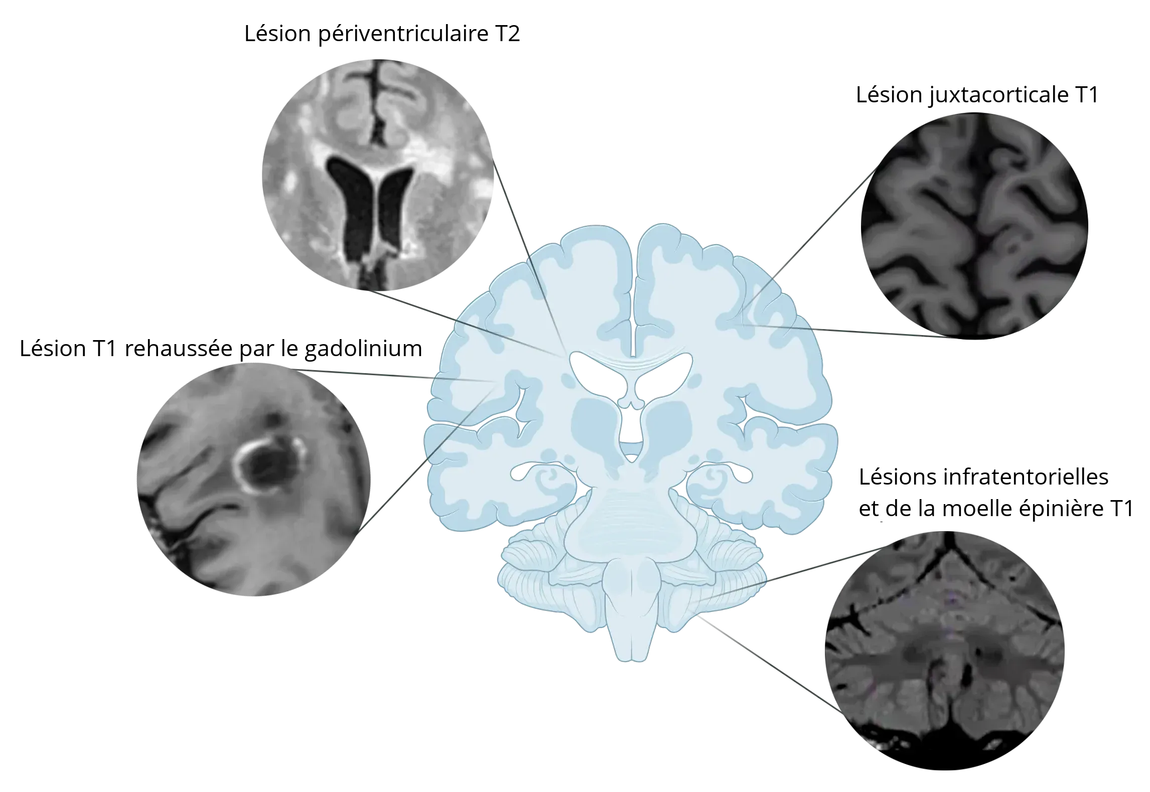 Lésions de SP à différents endroits du cerveau