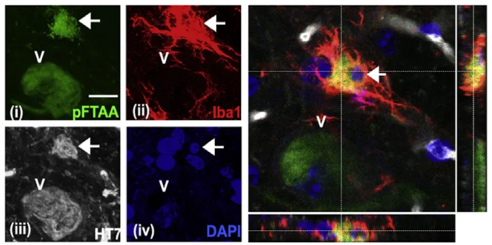 Engloutissement d'un neurone contenant des agrégats de tau