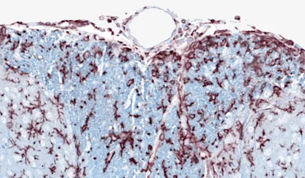 Multiple Sclerosis - a histological section of neural tissue stained to show cellular and structural details