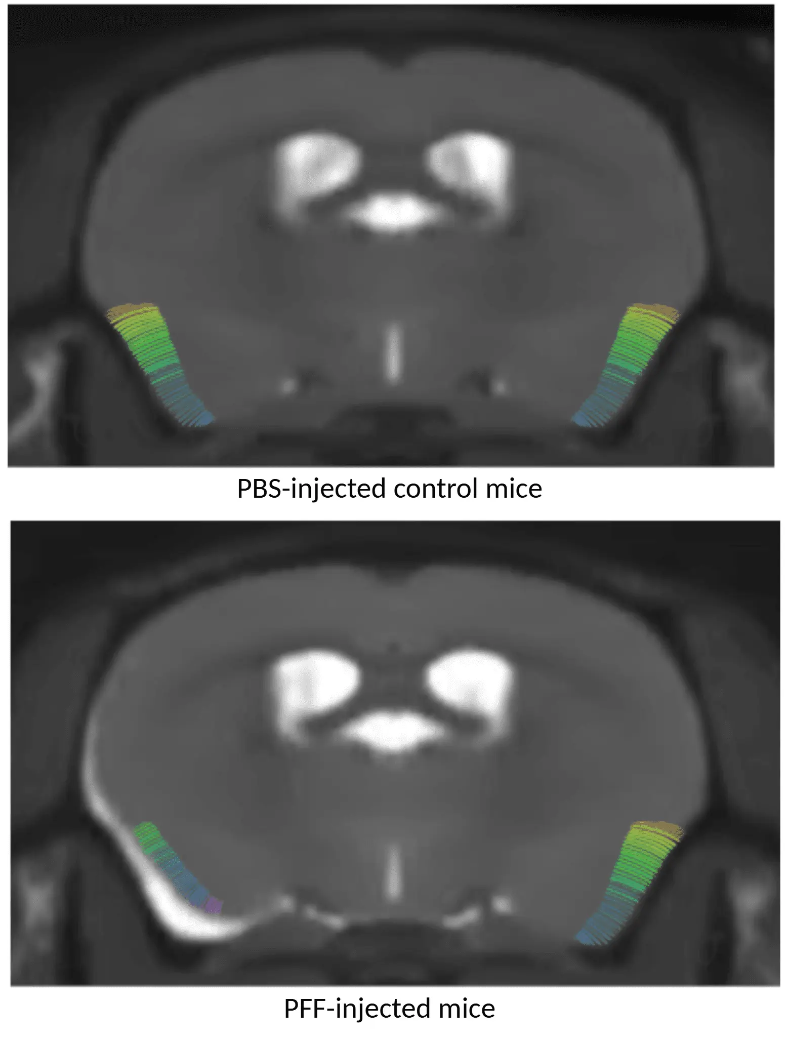 MRI cortical thickness maps