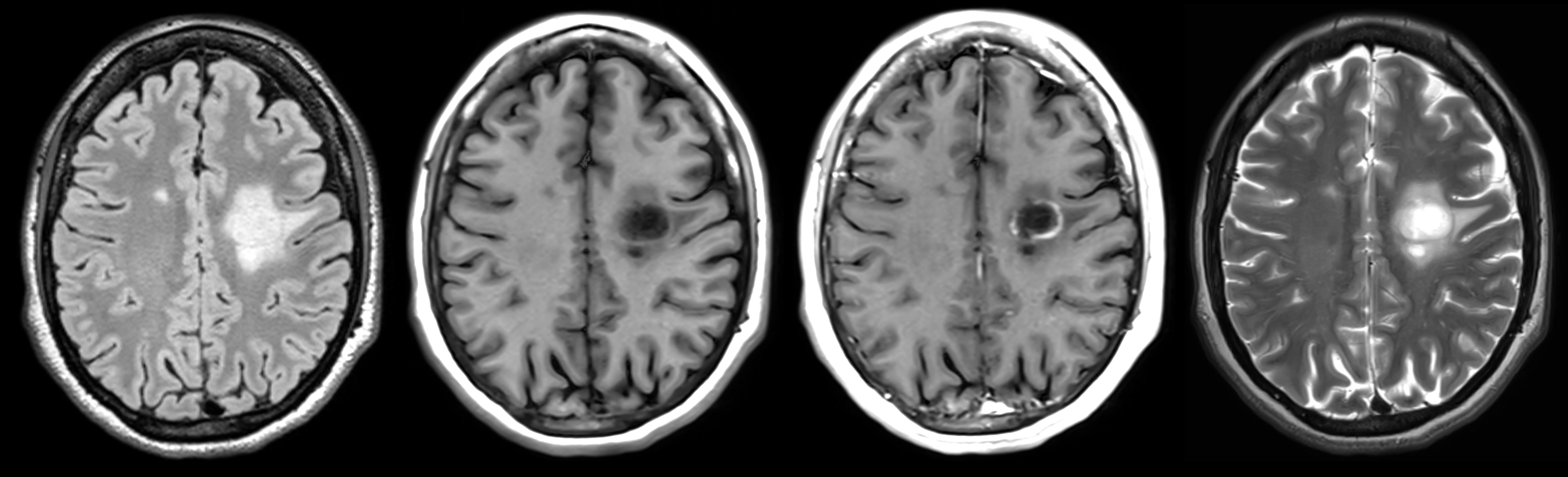 MRI modalities used as imaging endpoints in clinical trials