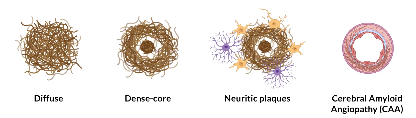 Illustration of the various types of amyloid-β plaques.