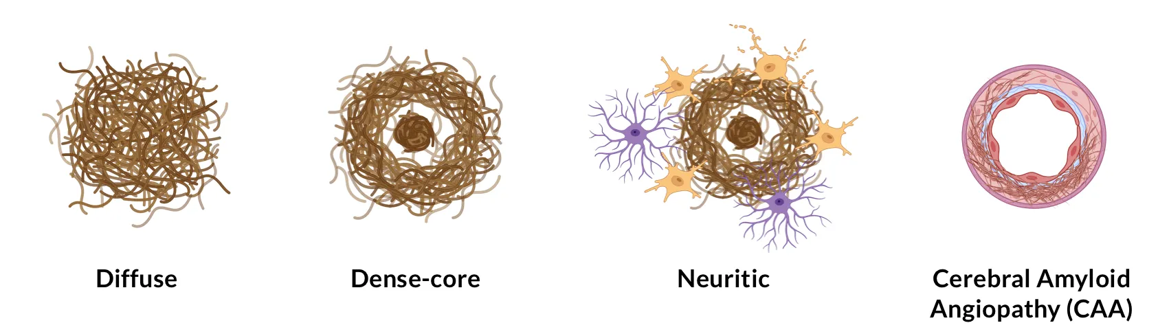 Illustration of the various types of amyloid-β plaques.