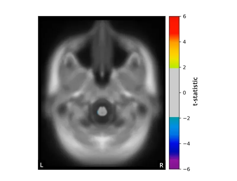 CBDと他のタウオパチーを区別するバイオマーカーのイメージング