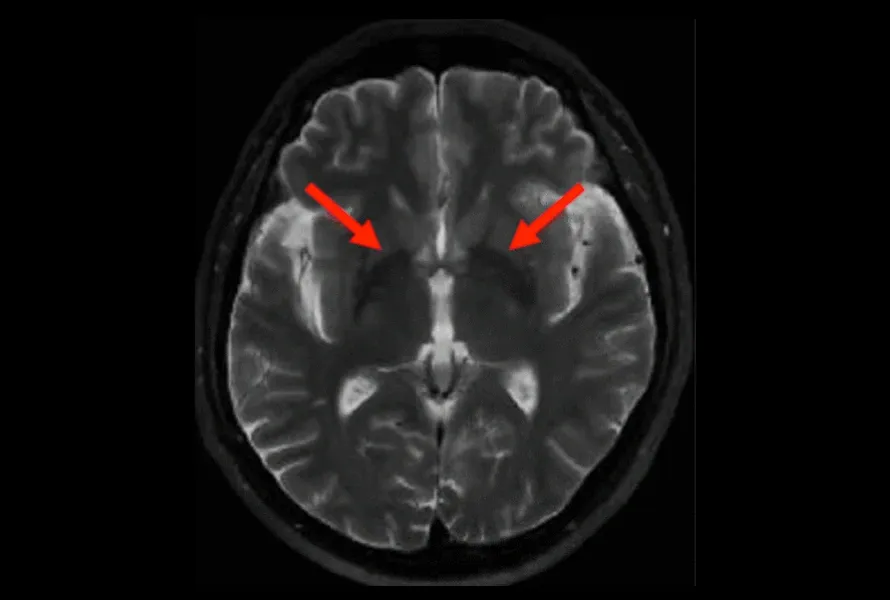 T2-weighted MR image showing putamen atrophy in an MSA subject