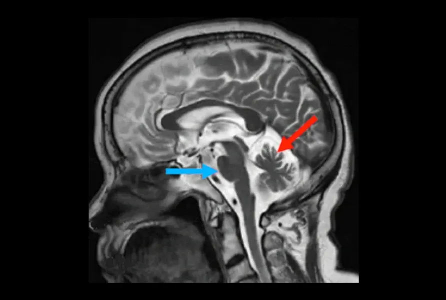 T2-weighted MR images showing pontine atrophy and cerebellar atrophy in an MSA subject