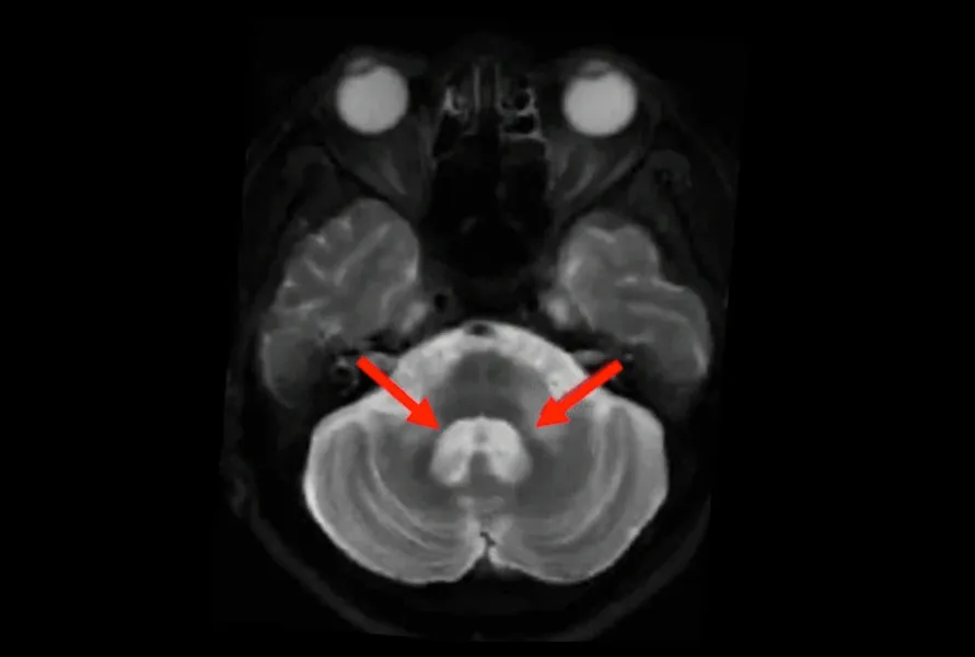 Images IRM pondérées en T2 montrant un signal hyperintense et une atrophie dans la MCP d'un sujet atteint de MSA