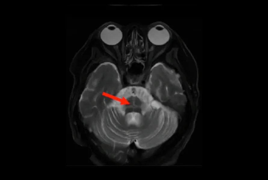 T2-weighted MR images showing the hot cross bun sign in the pons of an MSA subject