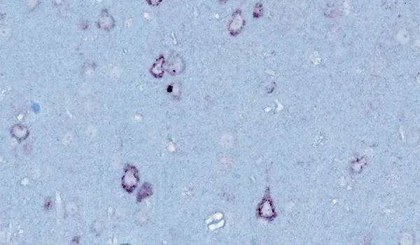 Microscopic view of a tissue sample stained to highlight the presence of phosphorylated TDP-43 (pTDP-43) protein