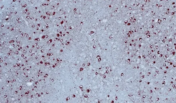 A microscopic view of brain tissue, specifically highlighting tau fibrils, which are associated with neurodegenerative diseases like Alzheimer's disease