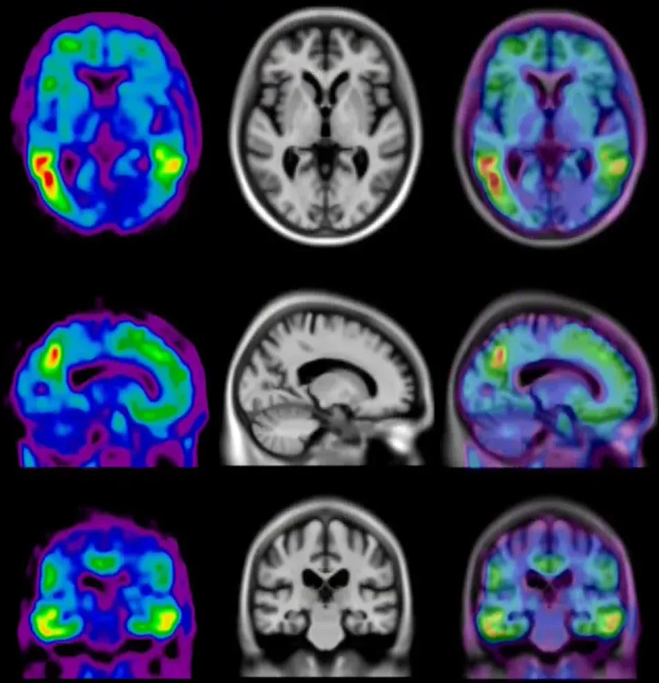 Vues orthogonales des TEP Tau et des IRM, et illustrations de la superposition des deux scans