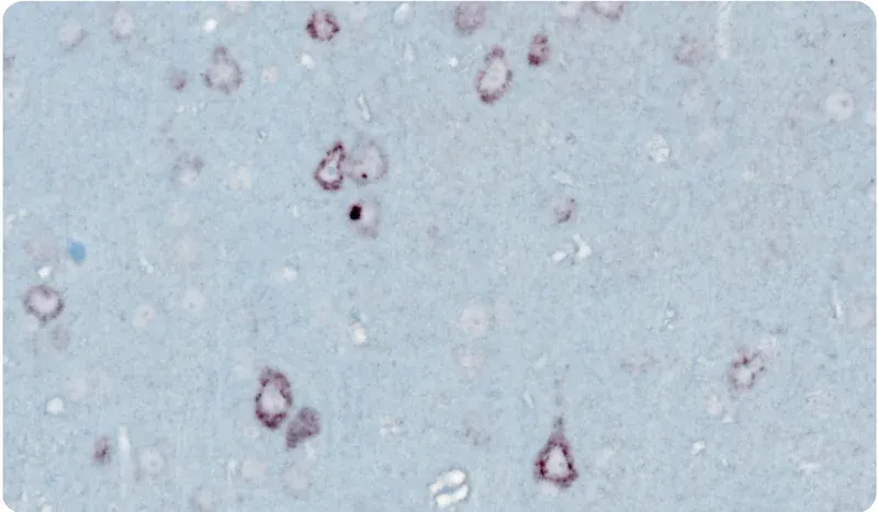 Microscopic view of a tissue sample stained to highlight the presence of phosphorylated TDP-43 (pTDP-43) protein